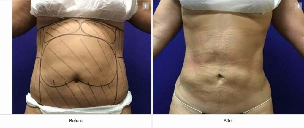 Smart Liposuction Triplex