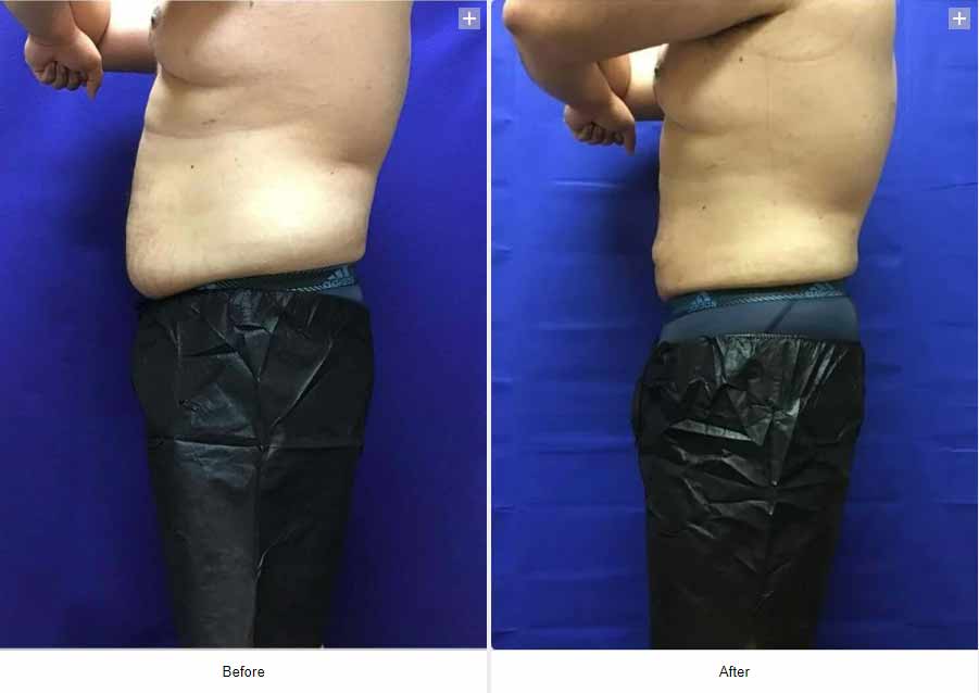 Smart Liposuction Triplex