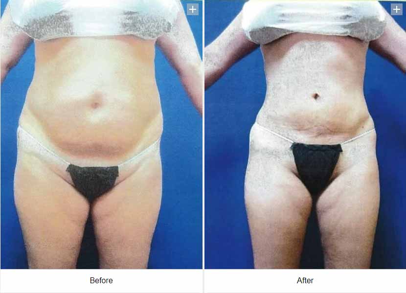 Smart Liposuction Triplex