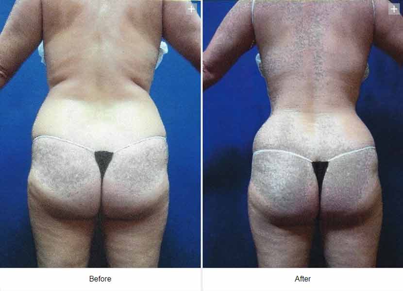 Smart Liposuction Triplex