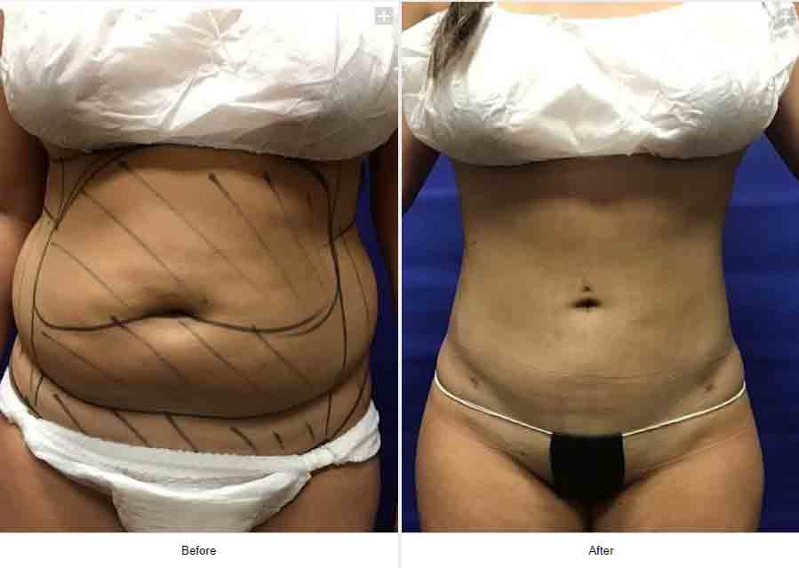 Smart Liposuction Triplex