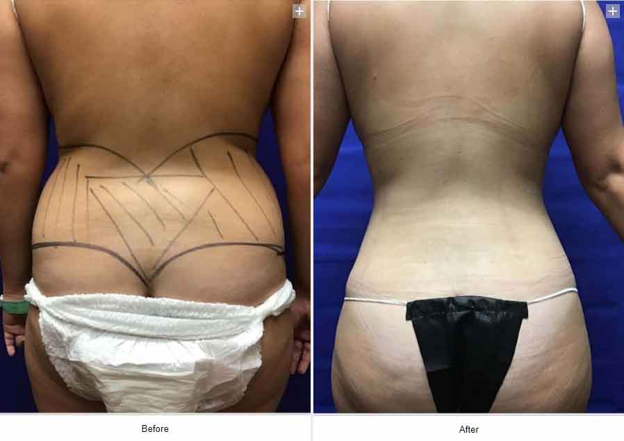 Smart Liposuction Triplex