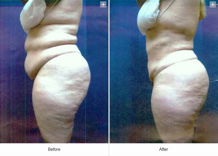 Smart Liposuction Triplex