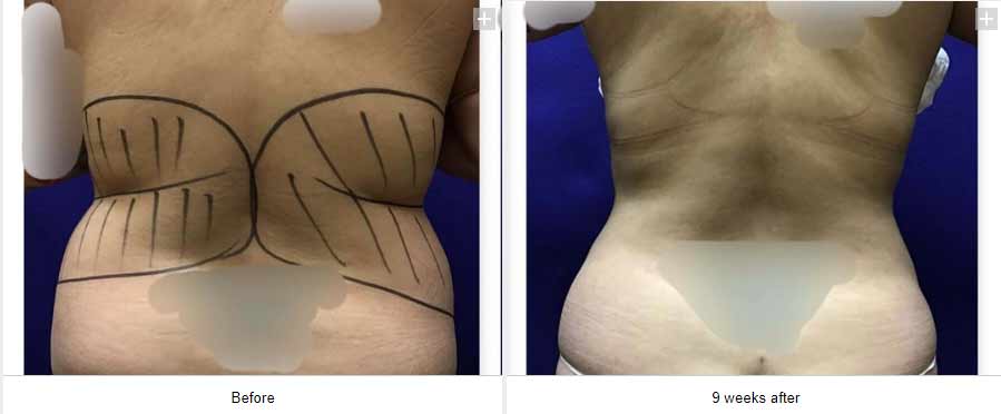 Smart Liposuction Triplex