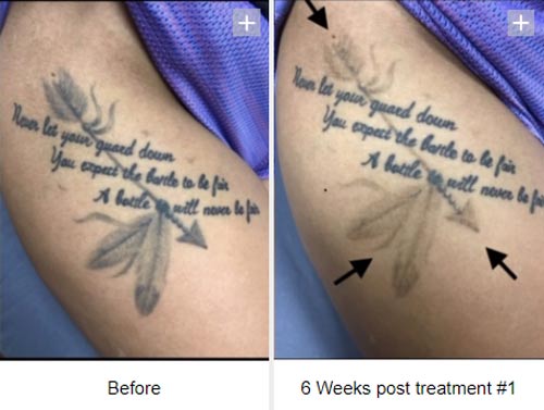 Laser Tattoo Removal