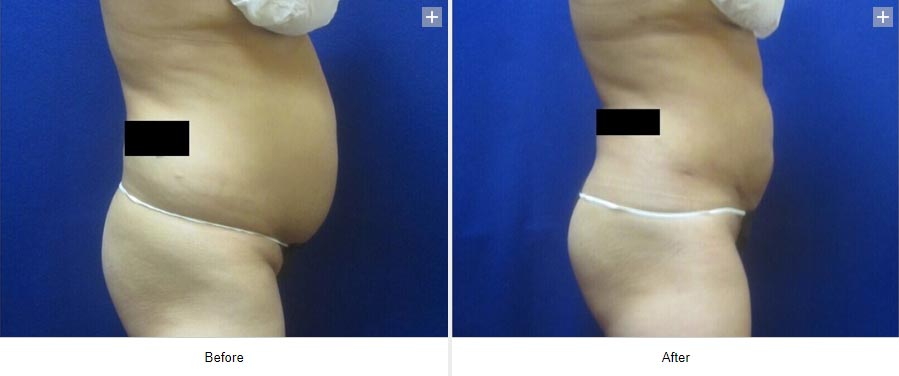 Smart Liposuction Triplex