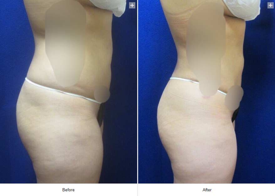 Smart Liposuction Triplex