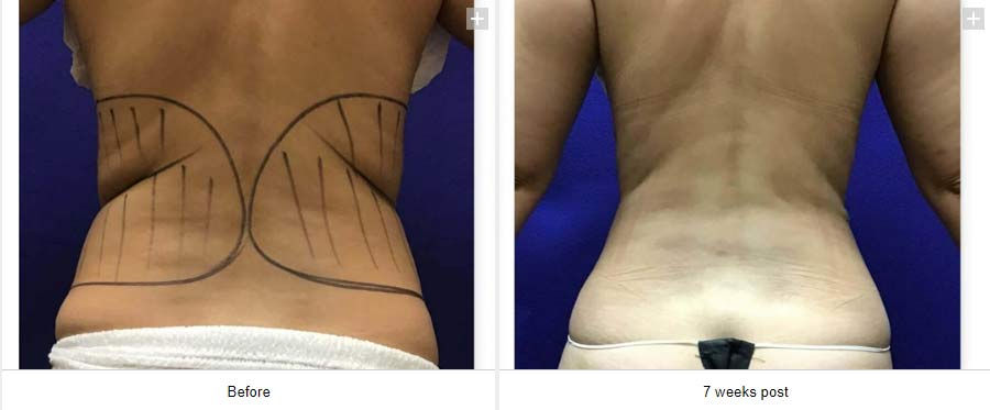 Smart Liposuction Triplex