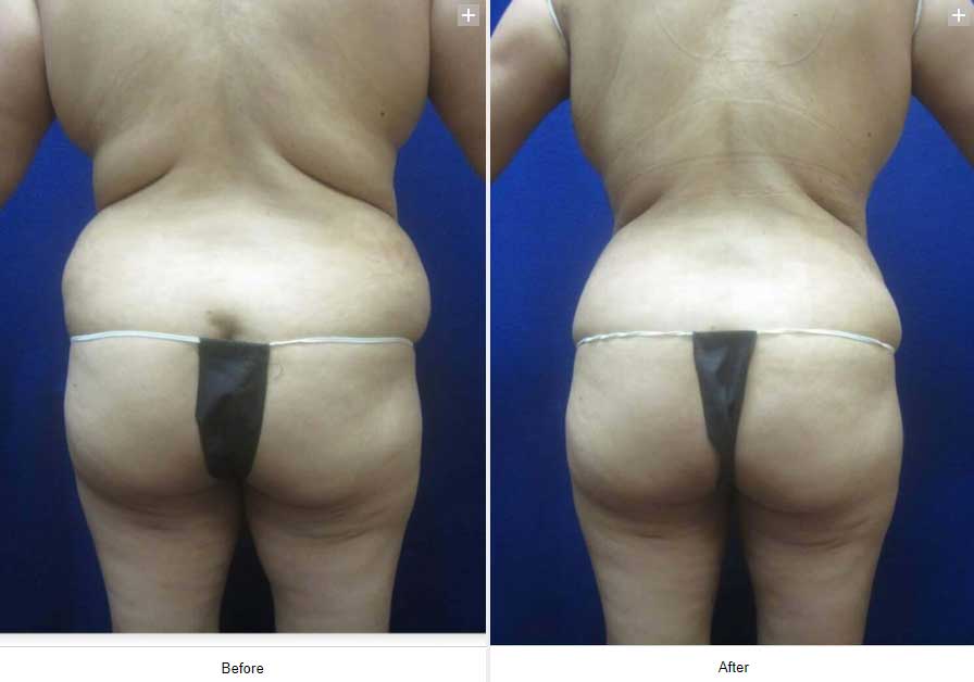 Smart Liposuction Triplex