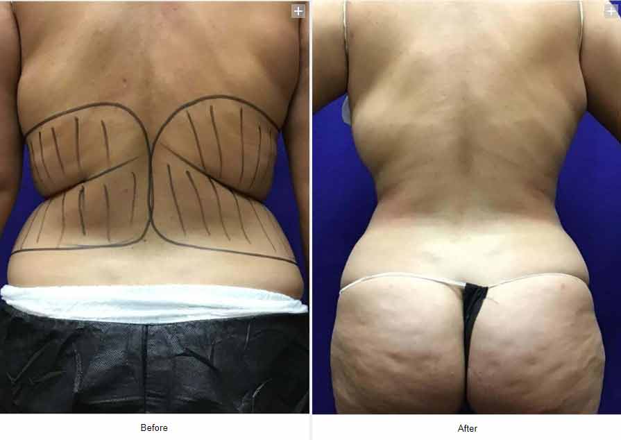 Smart Liposuction Triplex