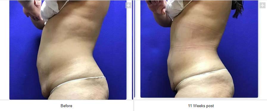 Smart Liposuction Triplex