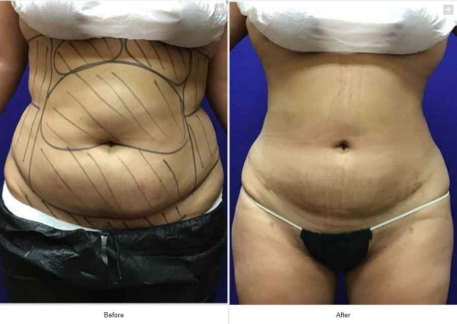 Smart Liposuction Triplex