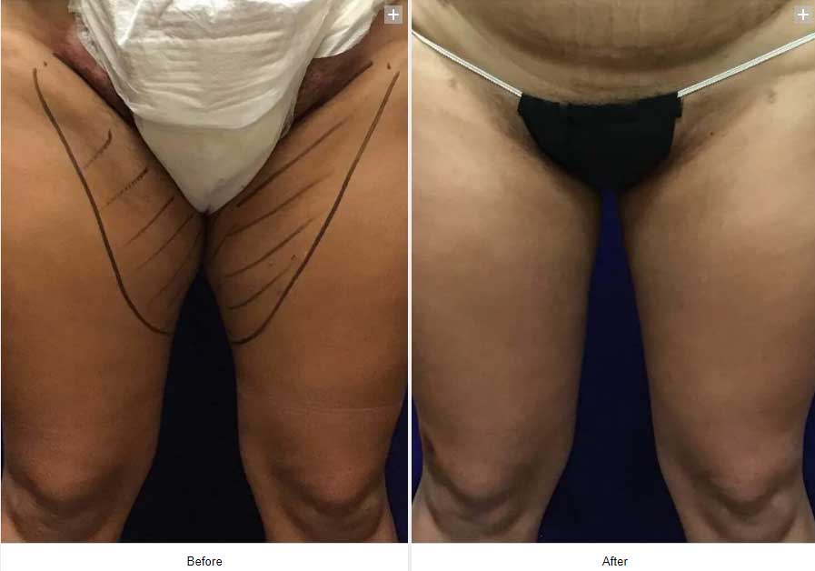 Smart Liposuction Triplex