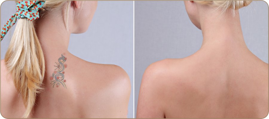 Cynosure PicoSure Laser Near Me Serving San Antonio, Seguin, TX Cynosure PicoSure Laser Near Me Serving San Antonio, Seguin, TX