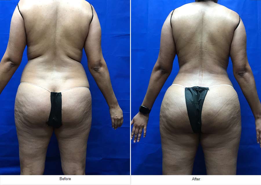 Liposuction - LCS Medical Spa in Seguin, TX