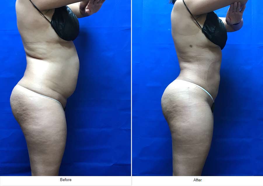 Liposuction - LCS Medical Spa in Seguin, TX