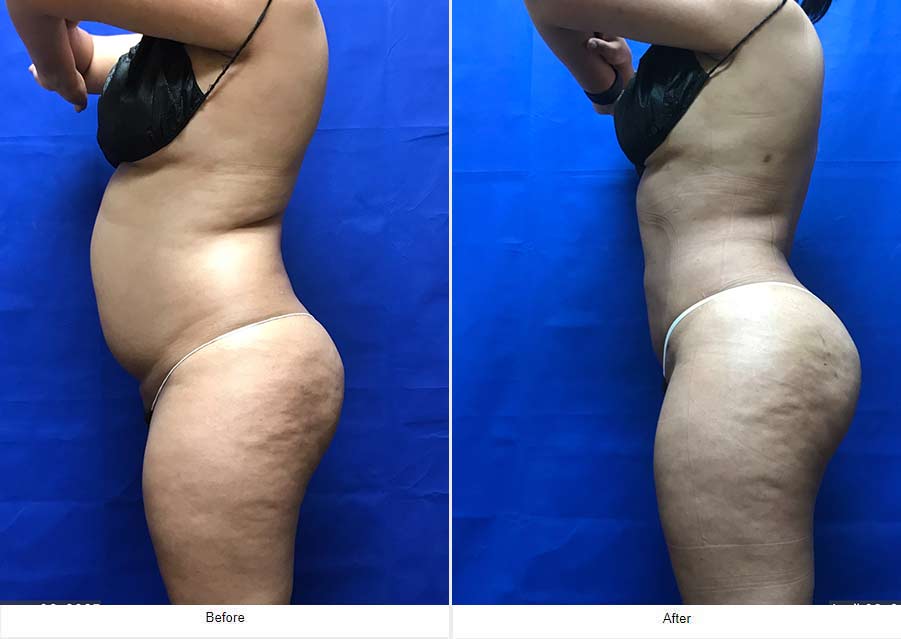 Liposuction - LCS Medical Spa in Seguin, TX