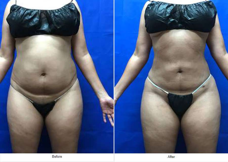 Liposuction - LCS Medical Spa in Seguin, TX