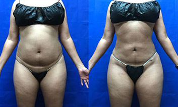 Liposuction Before & After Photos at LCS Medical Spa Serving San Antonio, Seguin, TX